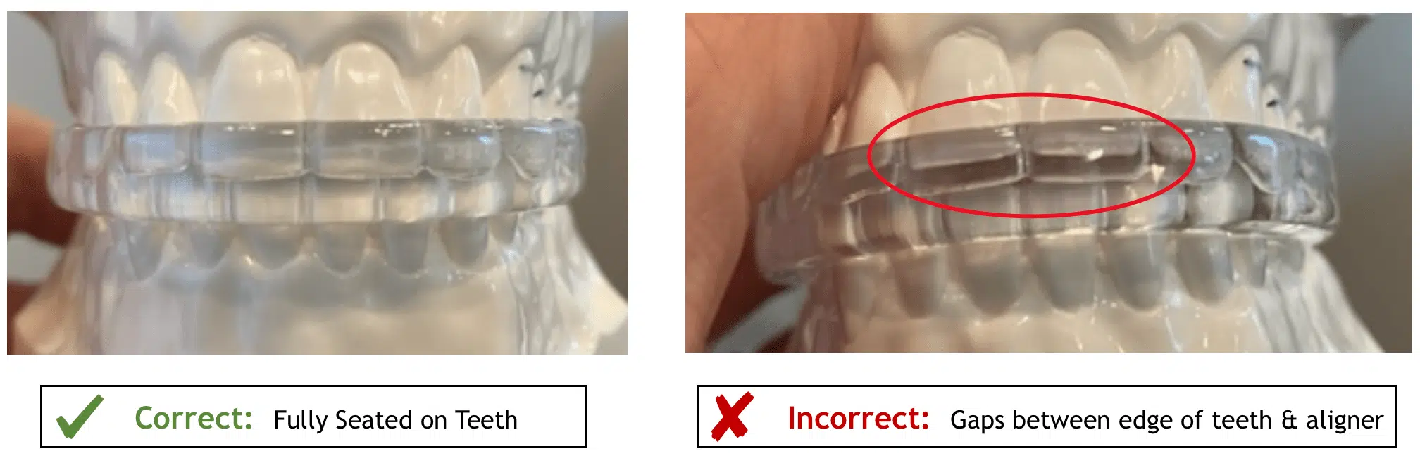 examples of correct and incorrect sleep apnea mouthguard alignment with teeth